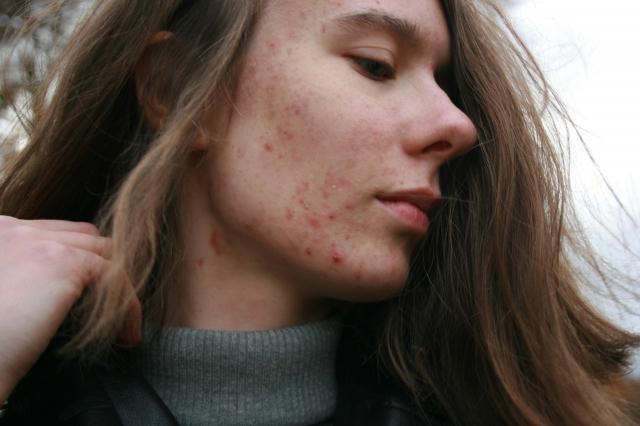 How Sleep Affects Skin Repair: Why Rest Matters for Acne Scar Recovery cover picture