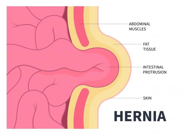 What Can Cause a Hernia? Diet, Age, and Genetics Explained cover picture