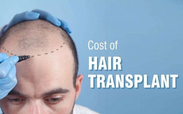 How Hair Transplants Help Cover Frontal Balding Issues? cover picture