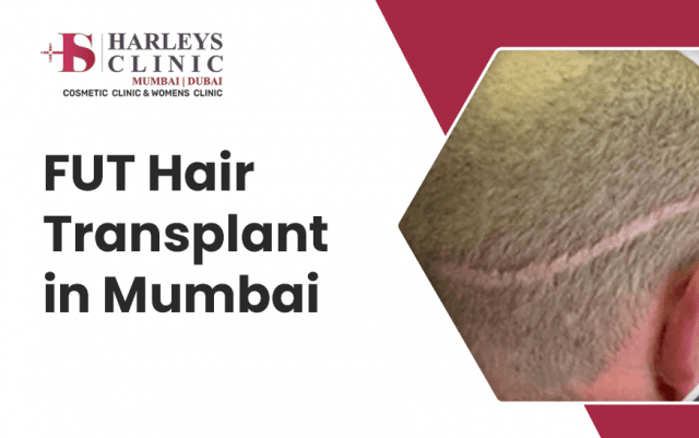 When Should You Get a FUT Hair Transplant? cover picture