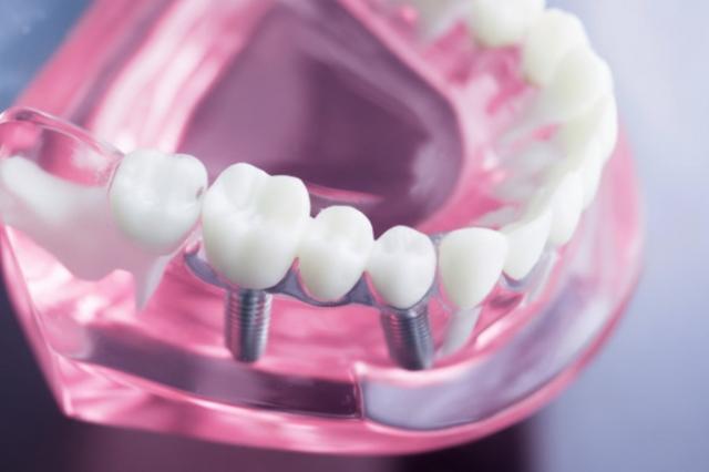 Dental Implants vs. Bridges: Which Is Right for You? cover picture