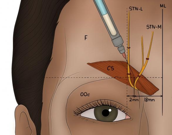 Botox and the Treatment of Chronic Migraines: Current Efficacy and Future Directions cover picture