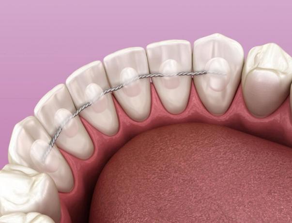 What You Need to Know Before Getting Permanent Retainers cover picture