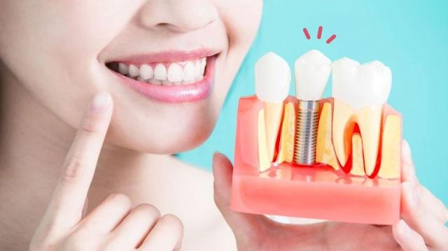 Everything You Need to Know About All on 4 Dental Implants cover picture
