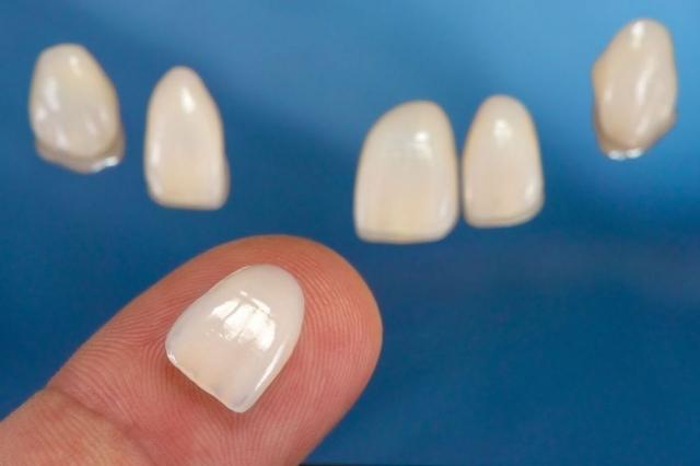 8 Types of Veneers: Which to Choose cover picture