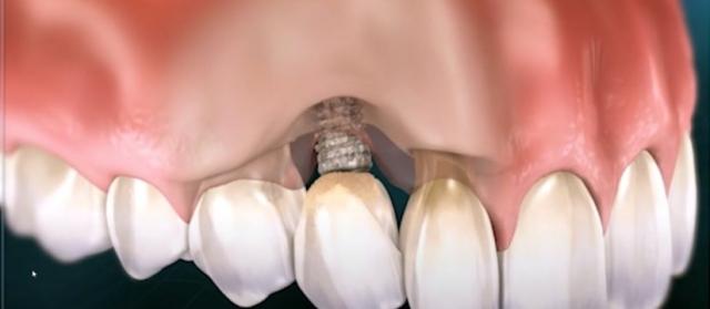 8 Common Causes of Dental Implant Failure cover picture