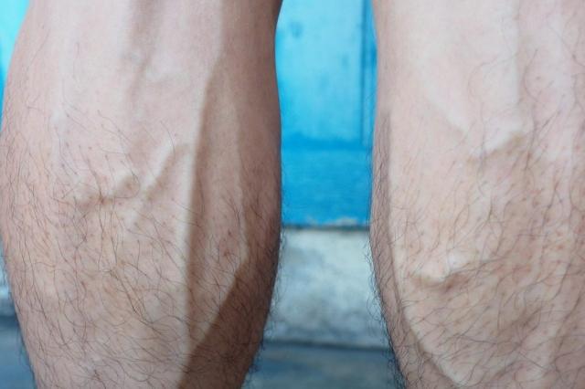 Bulging Veins: Symptoms, Causes and Treatment Options cover picture