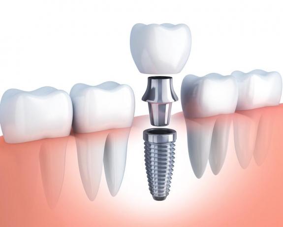 4 Signs You Need to Replace a Dental Implant Crown cover picture