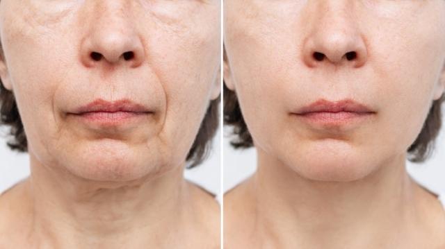 What You Need To Know About Face Lifts at Turkey cover picture