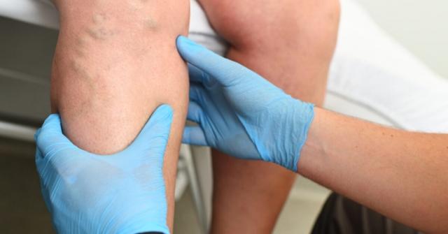 What is the Difference Between Sclerotherapy and Phlebectomy cover picture
