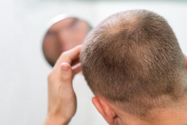 Unlocking Healthy Hair: How Scalp Micropigmentation Can Restore Confidence cover picture