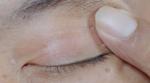Understanding Skin Tags Around Eyes: Causes, Treatment, and Prevention cover picture