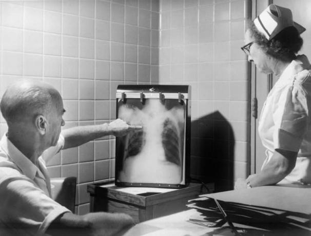 Pulmonary fibrosis; causes, symptoms, and possible treatment cover picture