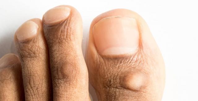 Corn Removal Surgery: What to Know About It to Be Ready cover picture