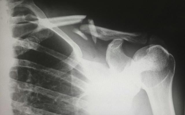 The Role of Rehabilitation After a Spinal Injury cover picture