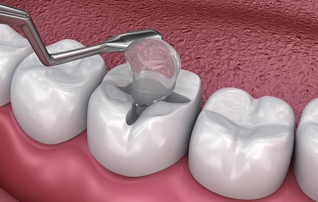 Tooth Filling Fell Out: Here's How to Handle It cover picture