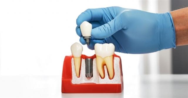 The Benefits of One Piece Implant cover picture