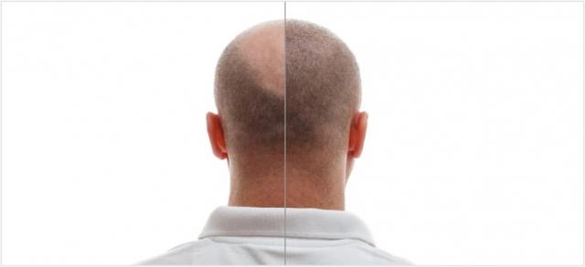 Why Do Most Men Need a Hair Transplant? cover picture