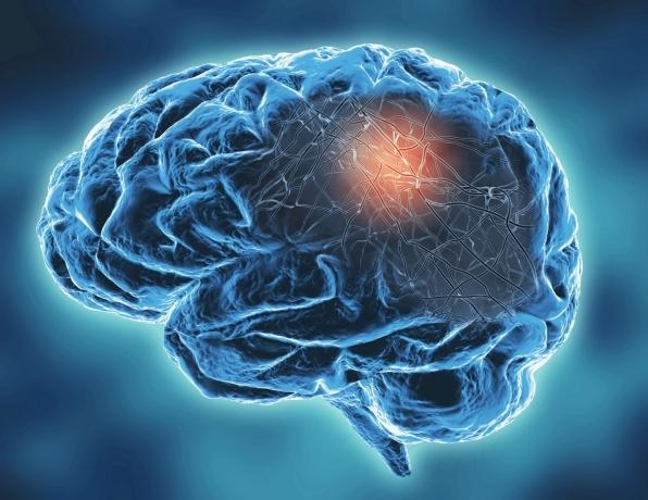 Top 5 Breakthroughs in Neurodegenerative Disorders cover picture