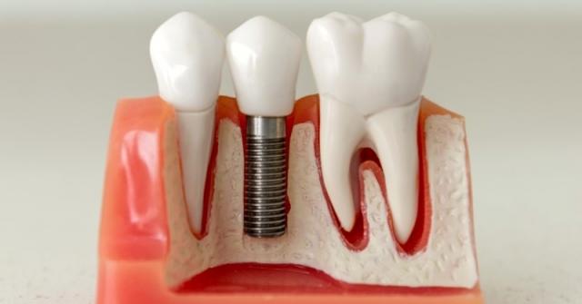 What Are the Top Materials for Dental Implants? cover picture