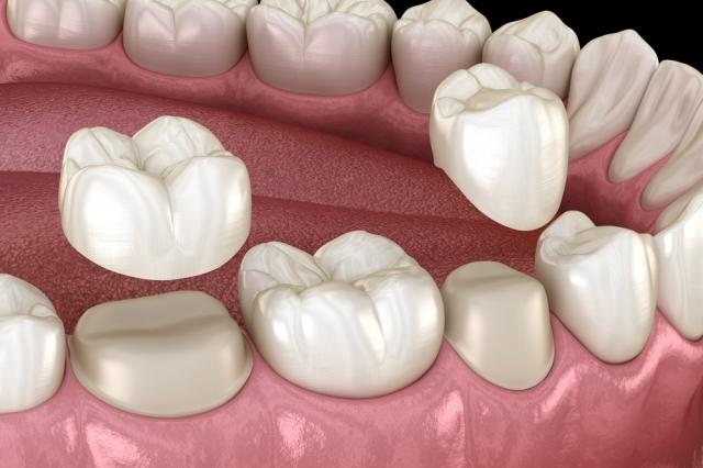 Getting a Dental Crown: Things to Know cover picture