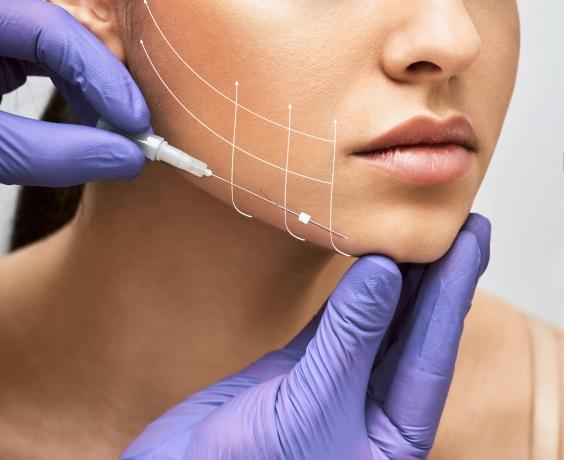 Double Eyelid Surgery and PDO Thread Lift in Sydney: Enhancing Your Appearance cover picture