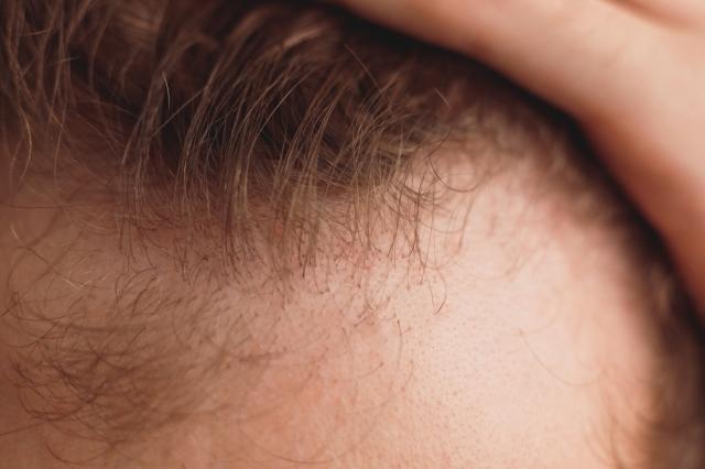 When To Consider a Hair Transplant cover picture