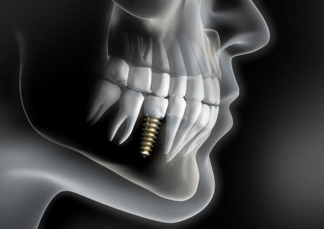 Understanding Dental Implant Systems: A Comprehensive Guide cover picture