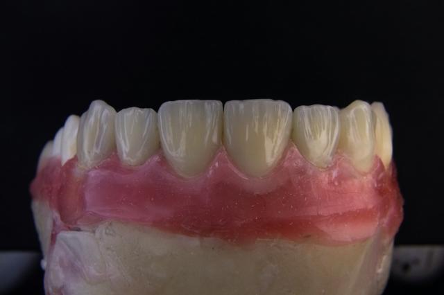 Smile with Confidence: How Dental Implants Can Boost Your Self-Esteem cover picture