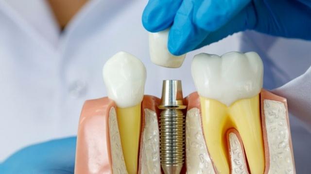 Debunking the Five Most Common Myths About Dental Implants cover picture