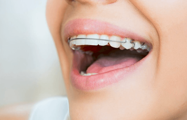 Comprehensive Guide to Retainers and Post-Treatment Care cover picture