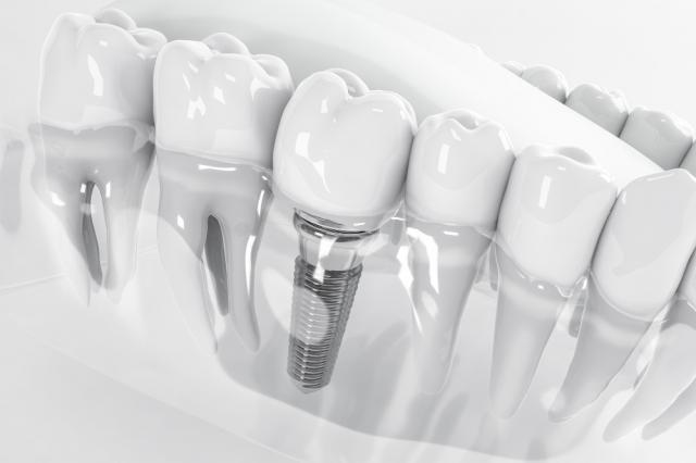 10 Myths Debunked About Single Tooth Implants cover picture