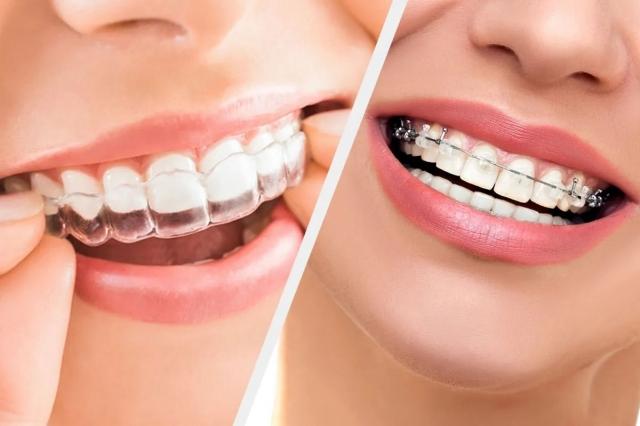 Invisalign vs. Traditional Braces: Which is the Right Choice for You cover picture