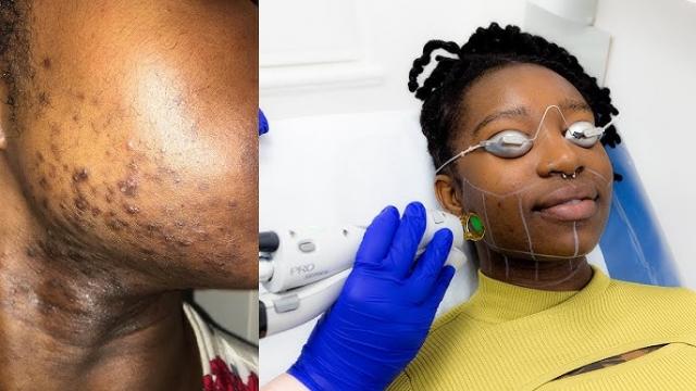 What to Know About Advanced Hair Removal Methods: Expert Tips cover picture