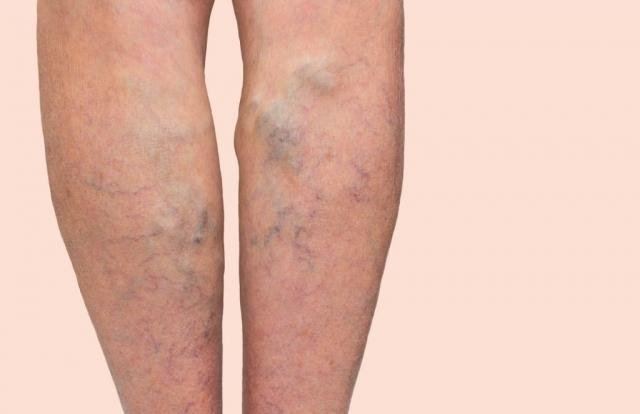 5 Myths About Varicose Veins: Are They Just a Cosmetic Issue? cover picture