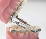 Everything You Need to Know About Dental Appliances