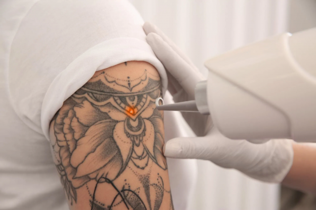 Confidence Starts with Clear Skin Dubai’s Best laser Tattoo Removal