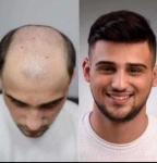 Hair Replacement in Mumbai | Restore Your Confidence with www.postcardtrip.in