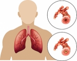 Chronic Obstructive Pulmonary Disease (COPD) Diagnosis Market is Estimated to Witness High Growth Owing to Advancements in Portable Spirometers