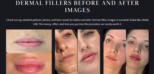 Enhance Your Lips with Lip Fillers in Dubai