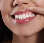 Gingivectomy, A Key to Healthier Gums and Teeth