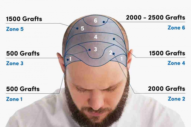 Hair Transplant 