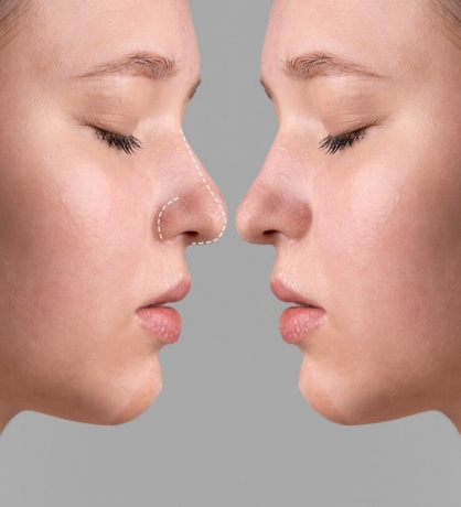 Rhinoplasty vs. Non-Surgical Nose Jobs: Which Is Right for You?