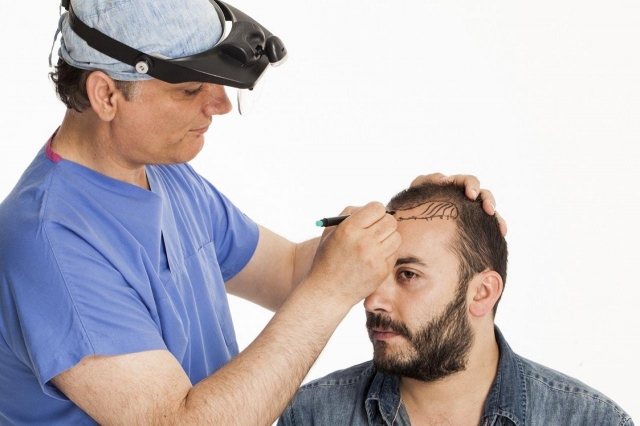 Male vs. Female Hair Transplant in Islamabad: Key Differences