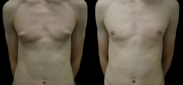 Best Gynecomastia Surgeon in Dubai: Top-Rated Specialists for Male Breast Reduction