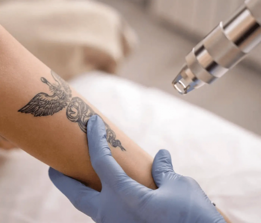 Tattoo-Free Skin in Record Time with Laser Technology in Dubai