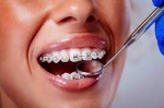Straight Teeth, Classic Style, The Metal Braces Solution