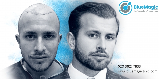 What are the Most Sophisticated Methods in Hair Transplant Clinics Nowadays?