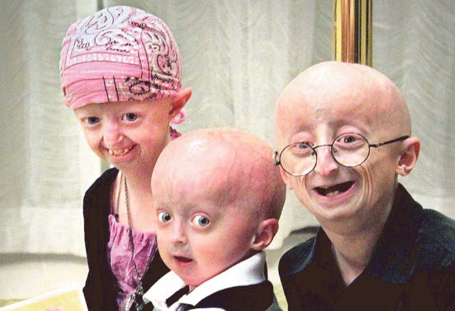 Emerging Treatments Offer Hope For Children With Progeria