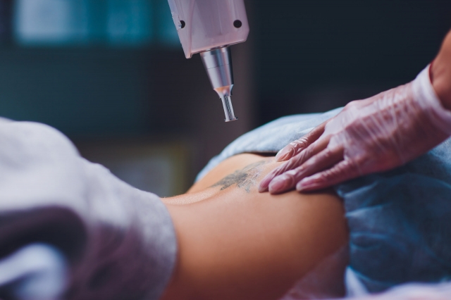 Clear Skin is Just a Session Away – Laser Tattoo Removal Dubai